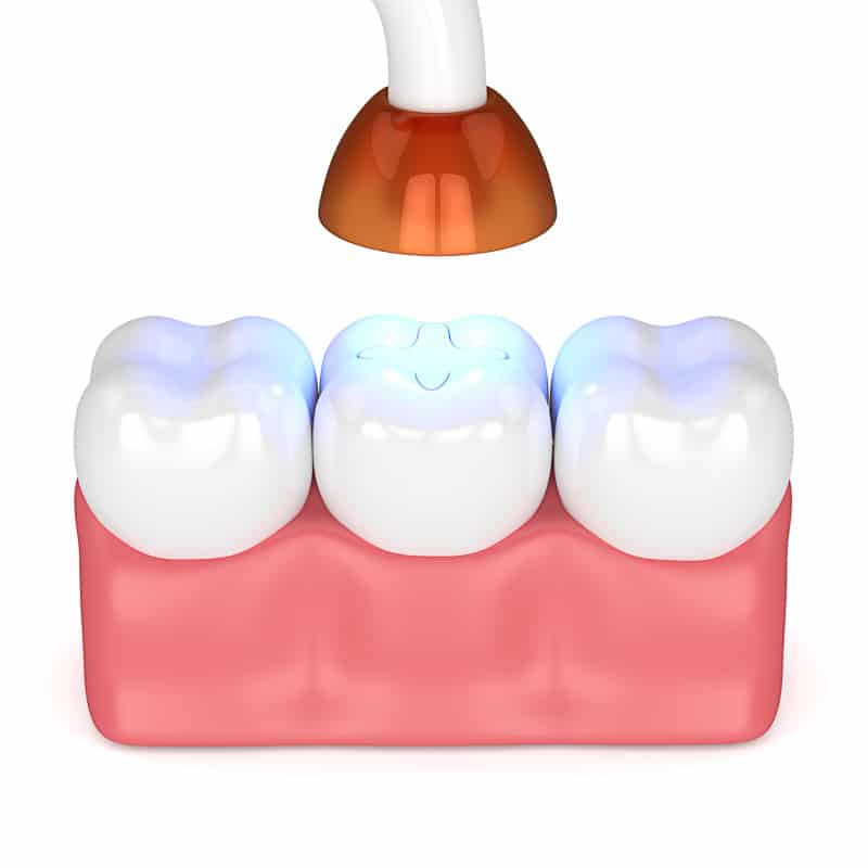 white fillings