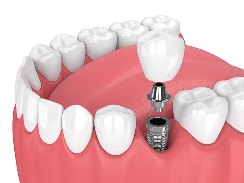 How a General Dentist Uses Crowns to Repair Teeth