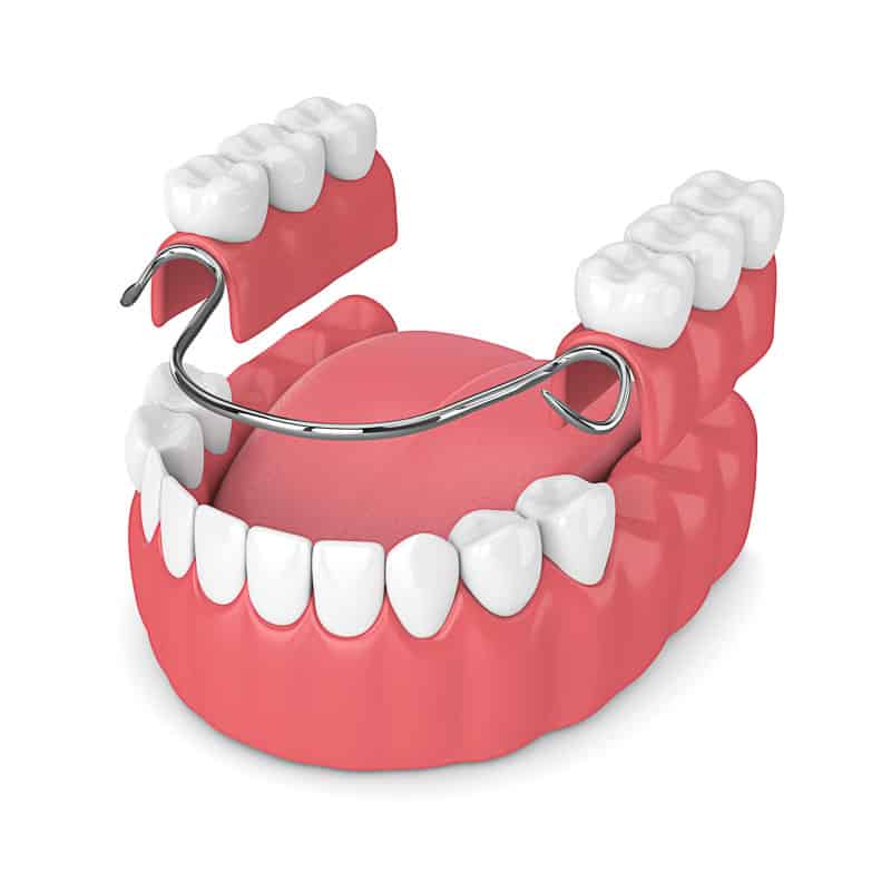 removable partial denture