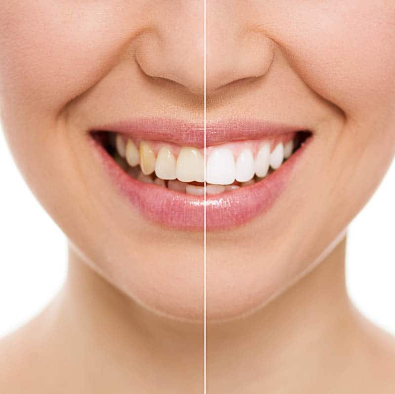 tooth whitening